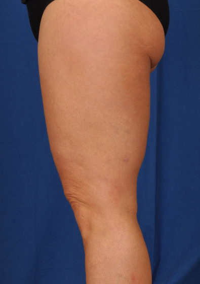 Legs Liposuction Before & After Patient #3136