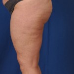 Legs Liposuction Before & After Patient #3143