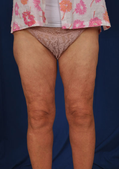 Legs Liposuction Before & After Patient #3143