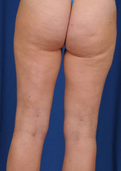 Legs Liposuction Before & After Patient #3148