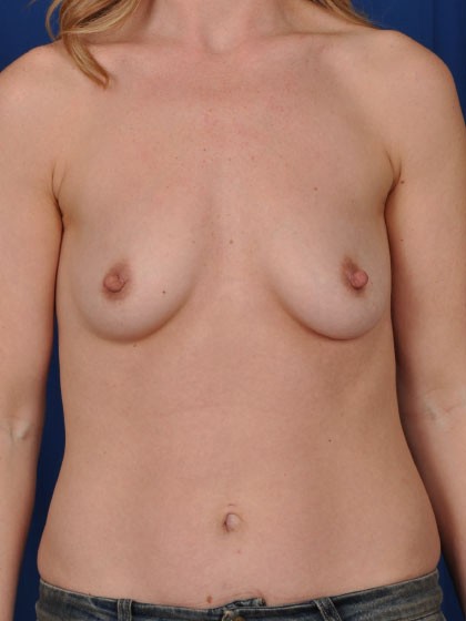Breast Augmentation Before & After Patient #3066