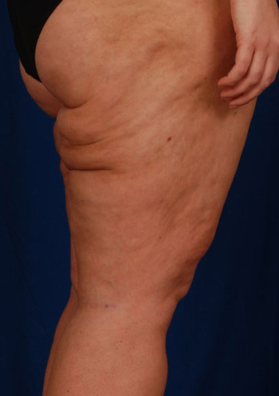 Legs Liposuction Before & After Patient #3156