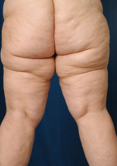Legs Liposuction Before & After Patient #3156