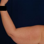 Arms Liposuction Before & After Patient #3171