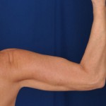 Arms Liposuction Before & After Patient #3166