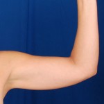 Arms Liposuction Before & After Patient #3220