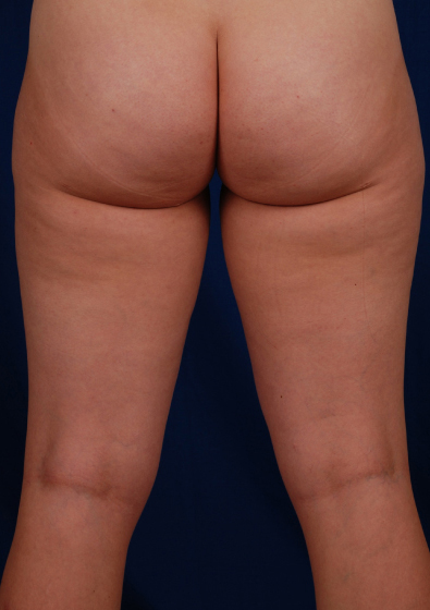 Legs Liposuction Before & After Patient #3208