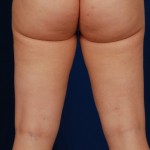 Legs Liposuction Before & After Patient #3208