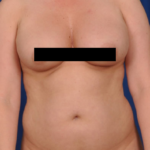 VASER Hi Def Liposuction Before & After Patient #3183