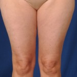 Legs Liposuction Before & After Patient #3194