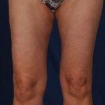 Legs Liposuction Before & After Patient #3194
