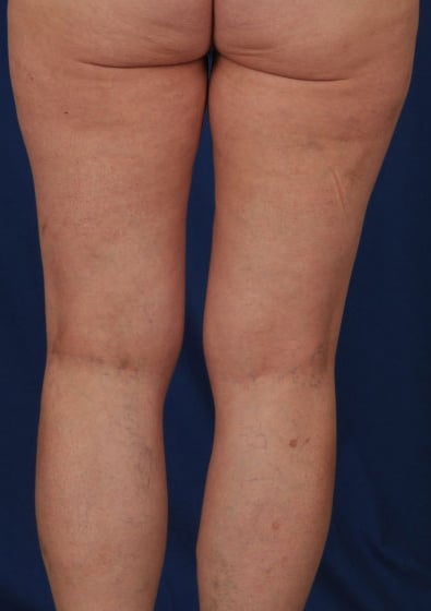 Legs Liposuction Before & After Patient #3214