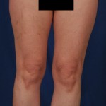 Legs Liposuction Before & After Patient #3217