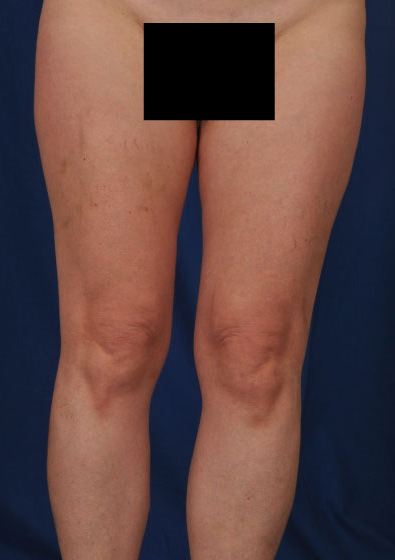 Legs Liposuction Before & After Patient #3217