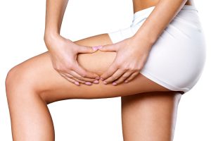 cellulite removal