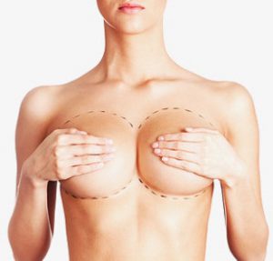 Options After Breast Implants Removal - SY Plastic Surgery