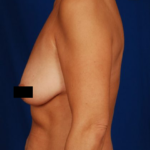 Tummy Tuck Before & After Patient #4401