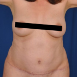 Tummy Tuck Before & After Patient #4414