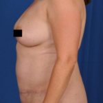 Tummy Tuck Before & After Patient #4414