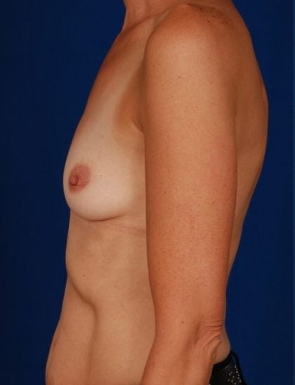 Breast Augmentation Before & After Patient #4422