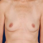 Breast Augmentation Before & After Patient #4431