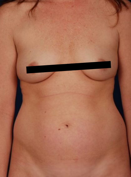 Tummy Tuck Before & After Patient #4440