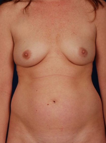 Tummy Tuck Before & After Patient #4440