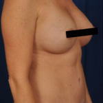 Tummy Tuck Before & After Patient #4440