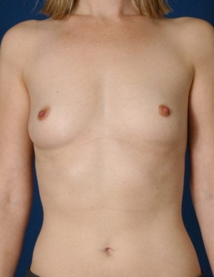 Breast Augmentation Before & After Patient #4468