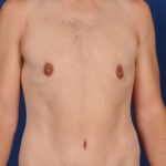 Gynecomastia Before & After Patient #4553