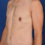 Gynecomastia Before & After Patient #4553