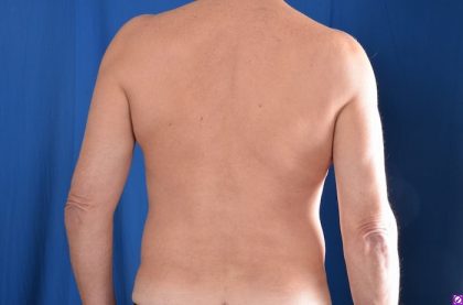 VASER Hi Def Liposuction Before & After Patient #4593
