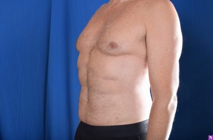 VASER Hi Def Liposuction Before & After Patient #4593