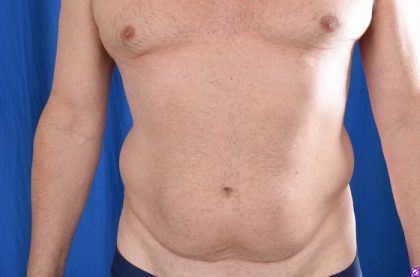 Patient #4593 VASER Hi Def Liposuction Before and After Photos