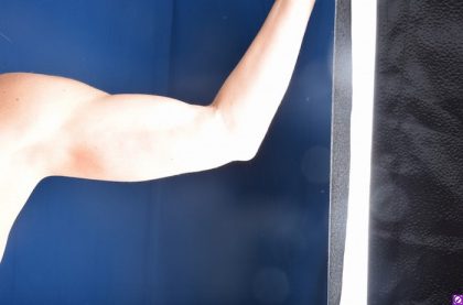 VASER Hi Def Liposuction Before & After Patient #4603