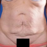 Tummy Tuck Before & After Patient #4590
