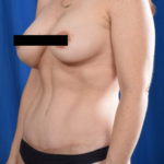 Tummy Tuck Before & After Patient #4650