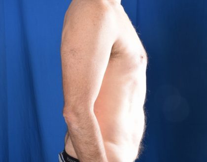 Gynecomastia Before & After Patient #4645