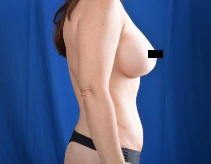 Tummy Tuck Before & After Patient #4650