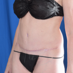Tummy Tuck Before & After Patient #4878