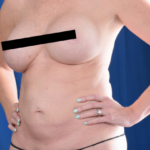 Tummy Tuck Before & After Patient #4878