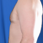 Gynecomastia Before & After Patient #4885