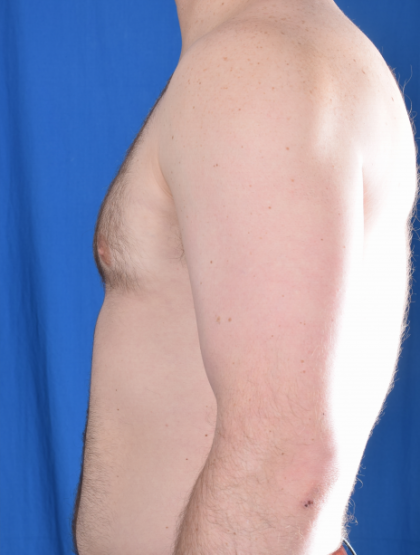 Gynecomastia Before & After Patient #4885
