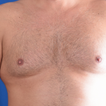 Gynecomastia Before & After Patient #4895