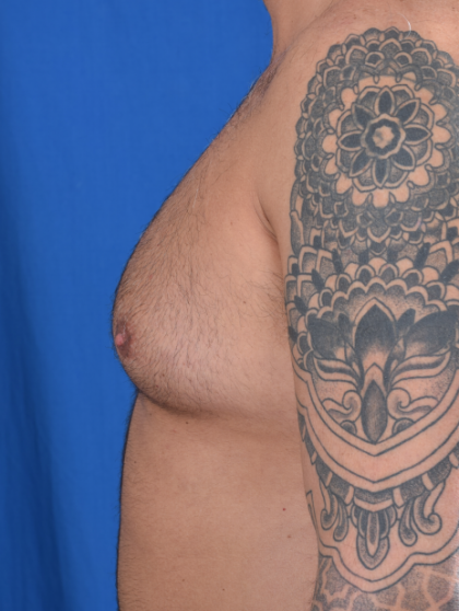Gynecomastia Before & After Patient #4895