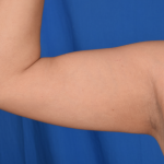 Arms Liposuction Before & After Patient #4910