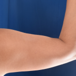 Arms Liposuction Before & After Patient #4910