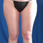 Legs Liposuction Before & After Patient #4917