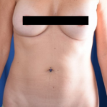 VASER Hi Def Liposuction Before & After Patient #4932