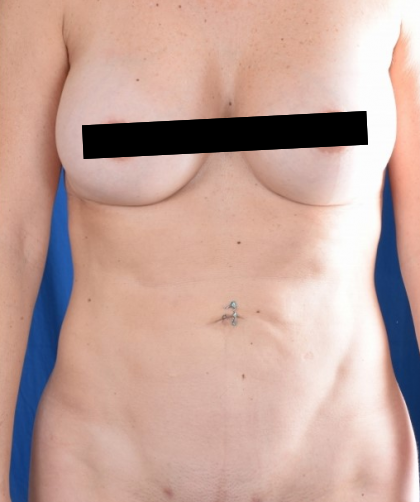 VASER Hi Def Liposuction Before & After Patient #4932